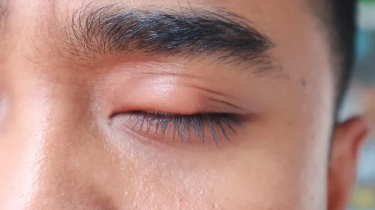 Beispiel für ein geschwollenes Auge bei einem Mann